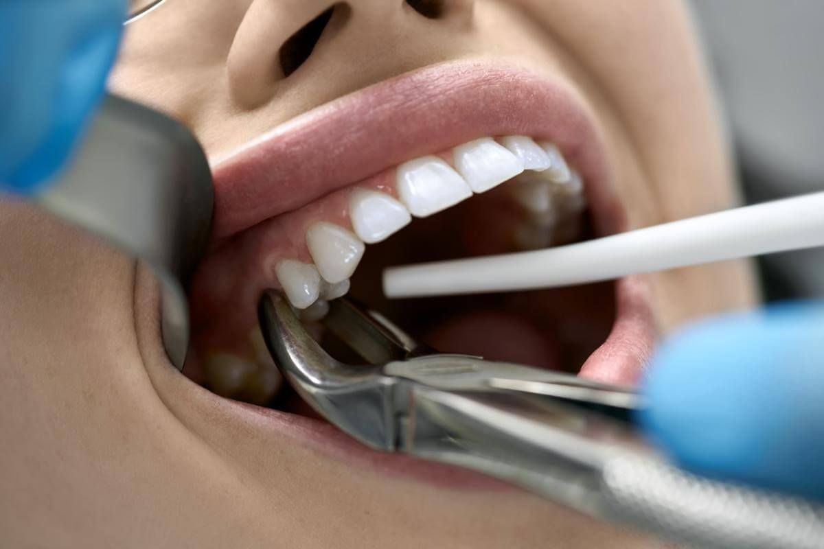 Dental extraction forceps in use during a tooth extraction